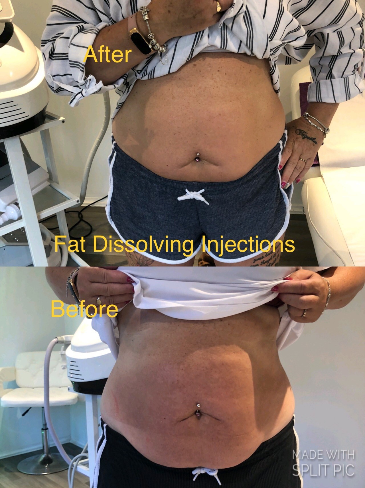 fat_dissolving_injections_3