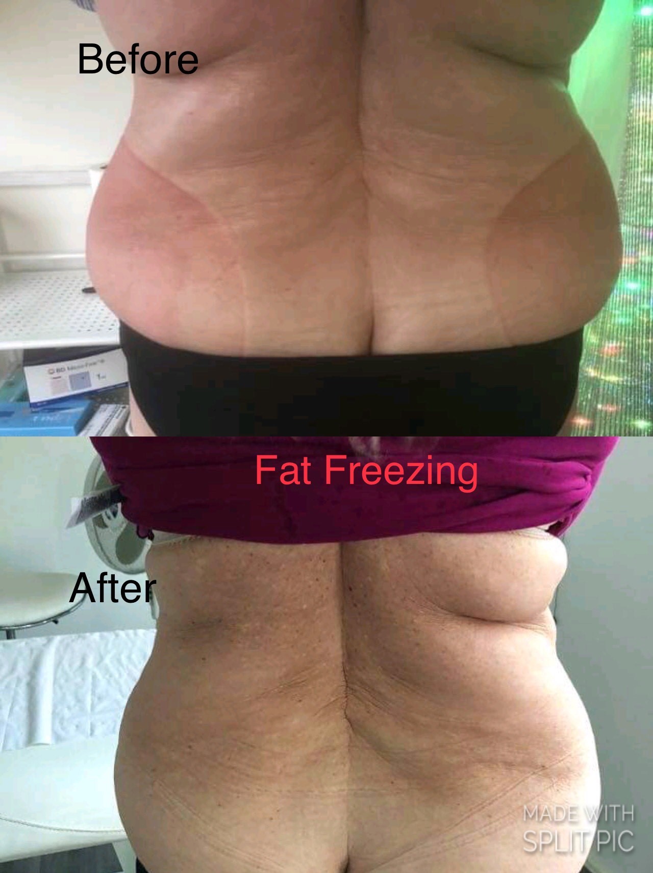 fat_freezing_6