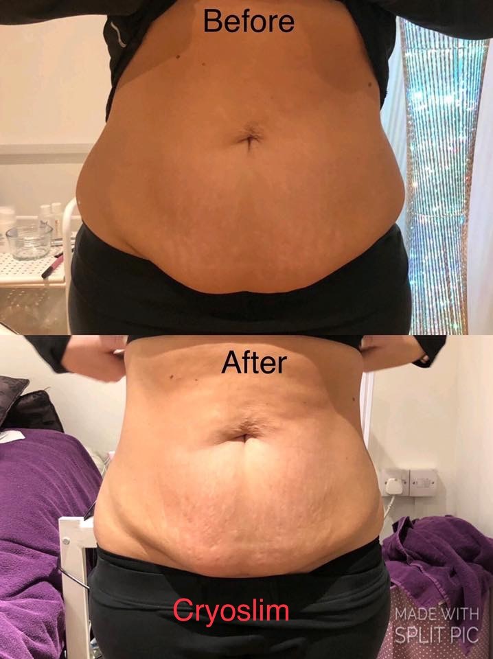 cryoslim_1