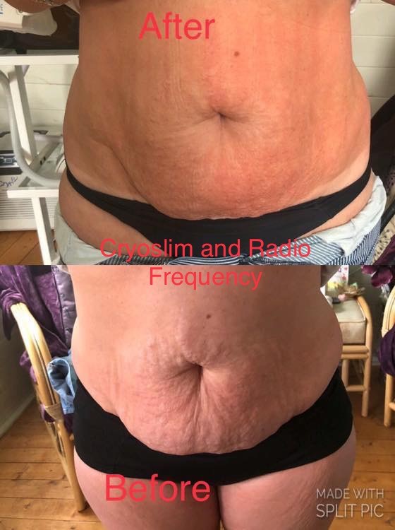 cryoslim_radio_freq_1