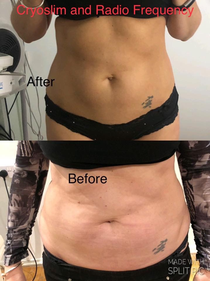 cryoslim_radio_freq_2