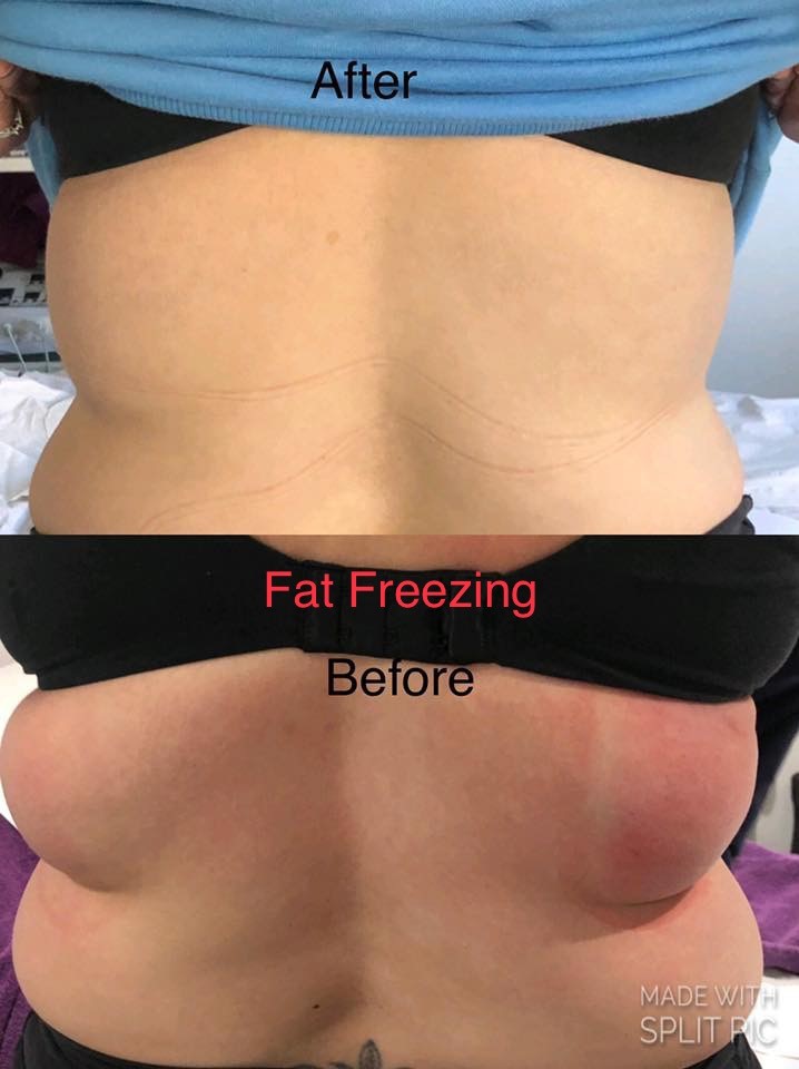 fat_freezing_1
