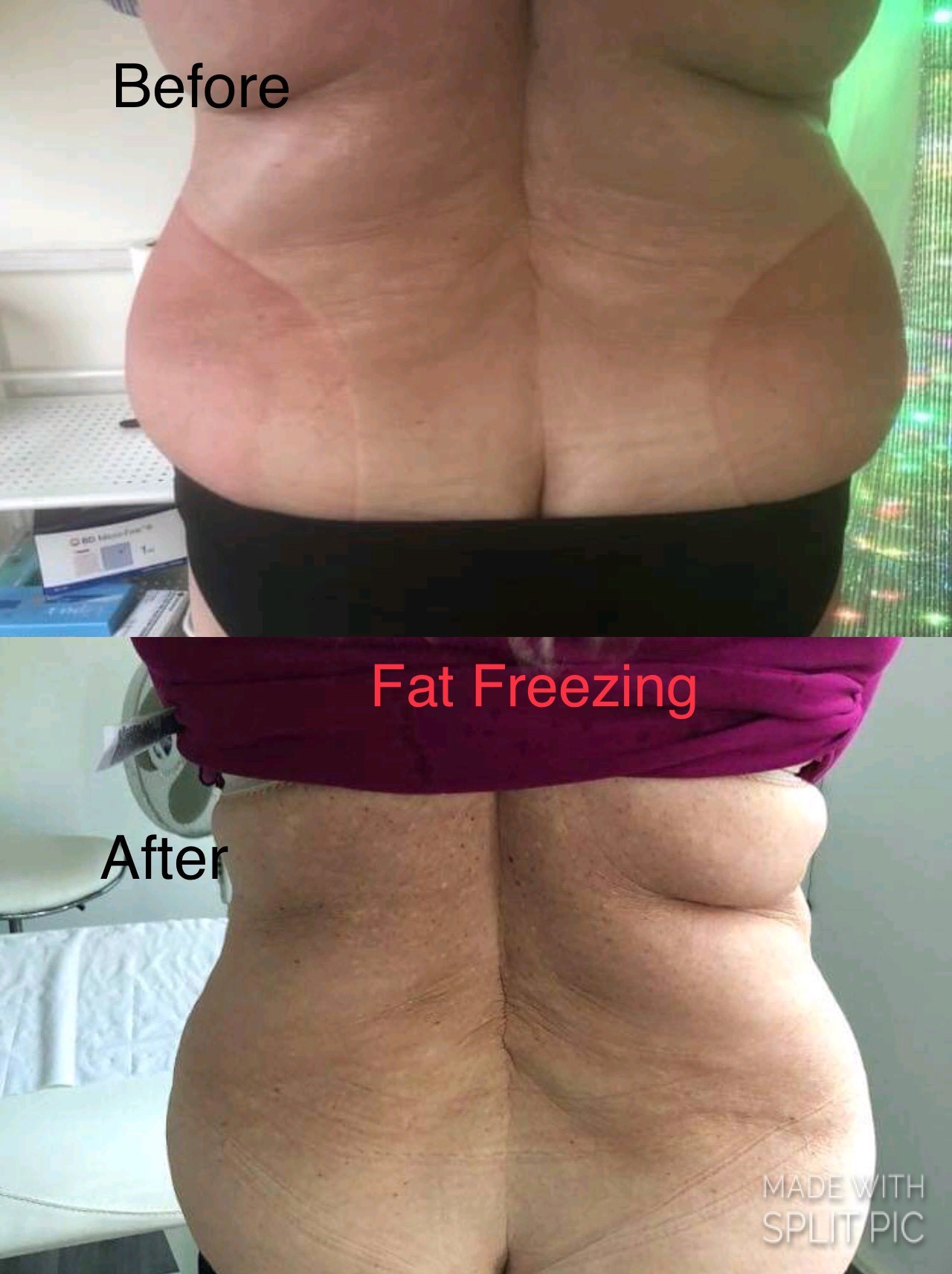fat_freezing_12
